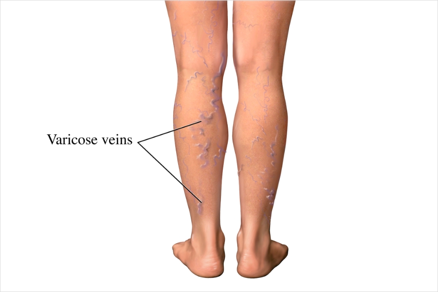 varicose-veins-varicose-veins-nhlbi-nih