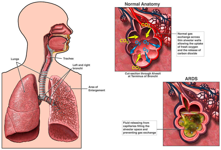 acute-respiratory-distress-syndrome-causes-and-risk-factors-nhlbi-nih