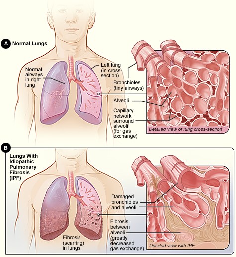 obstructive-vs-restrictive-lung-disease