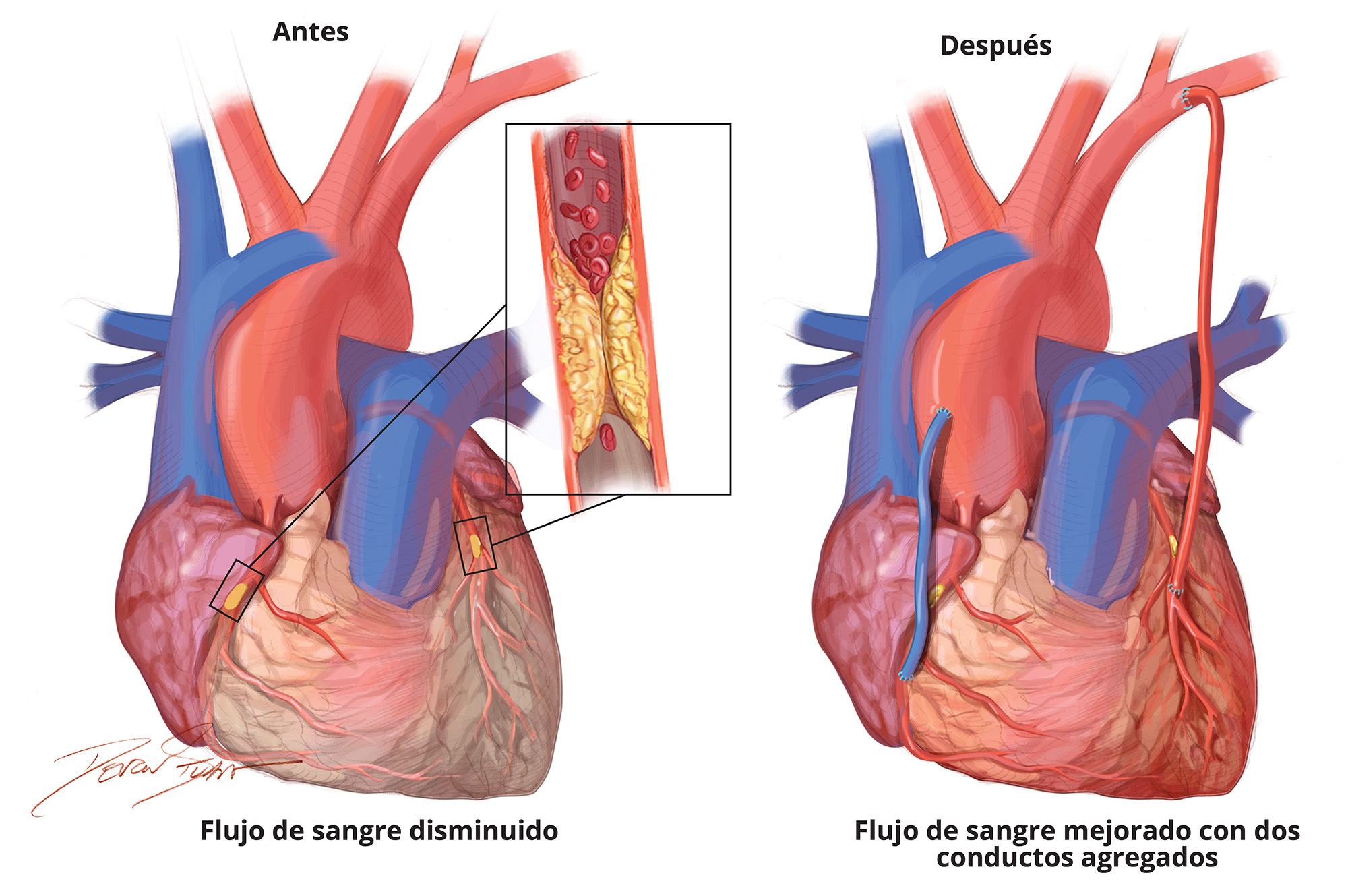 Spanish Coronary Artery Bypass