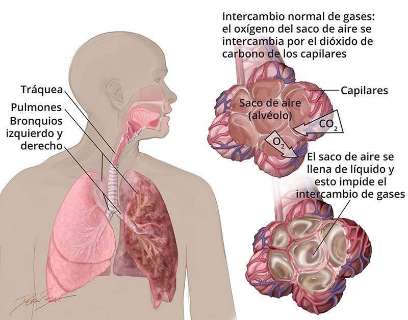 Ilustración de SDRA