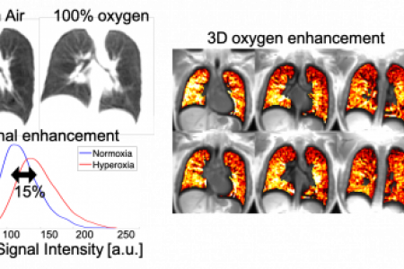 Measurement of regional lung function using oxygen-enhanced MRI. 