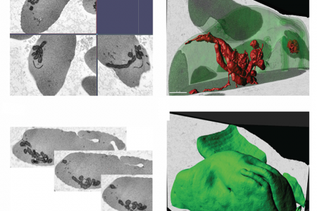 Electron microscopy analysis of sickle cell disease red blood cells (RBCs). 